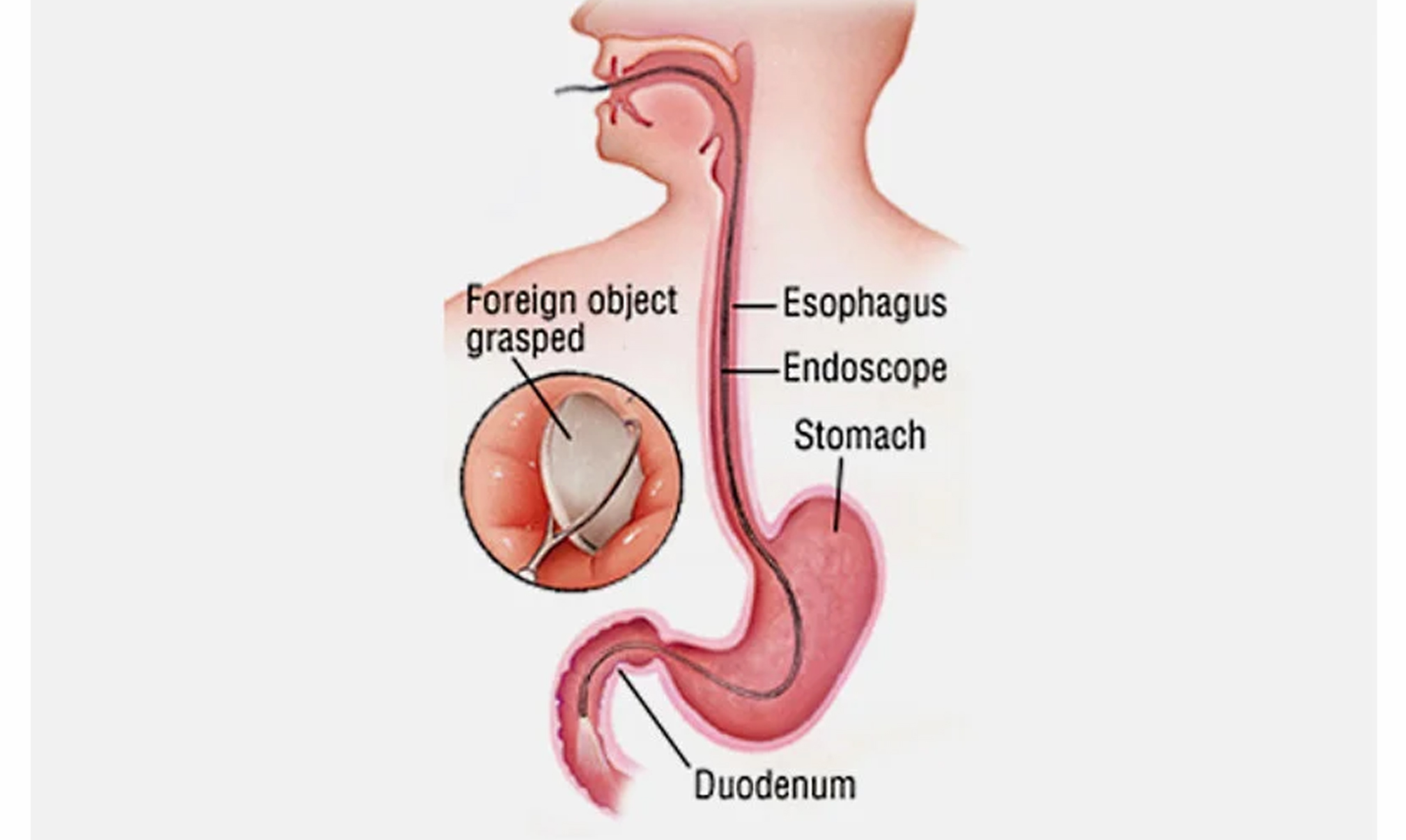 Foreign body removal