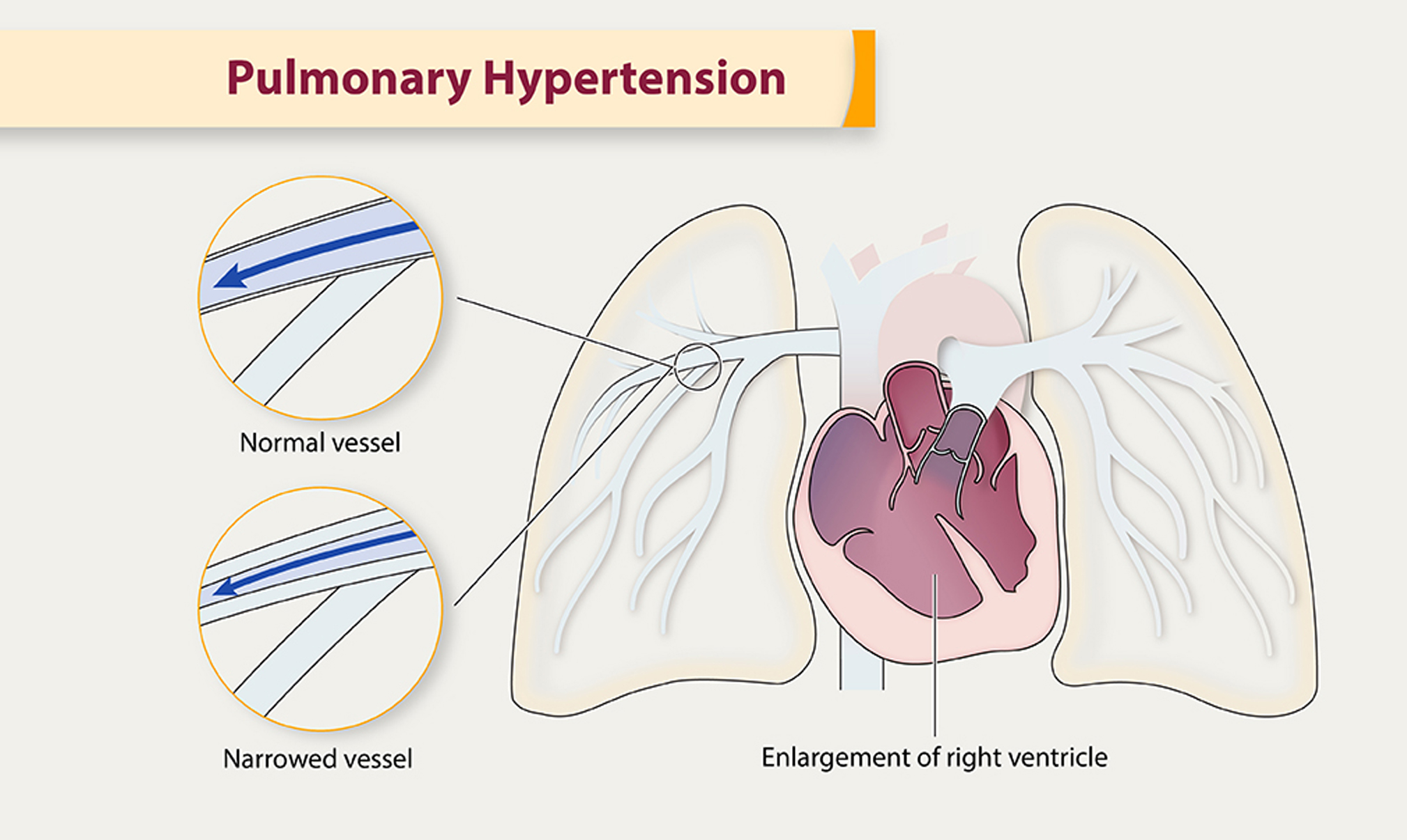 Pulmonary Hypertension Care